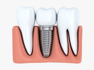 Dental Implants | Dentist Wantirna South