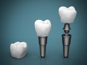 who-performs-a-dental-implant-procedure-and-how-much-do-they-cost
